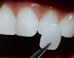 dental_veneer